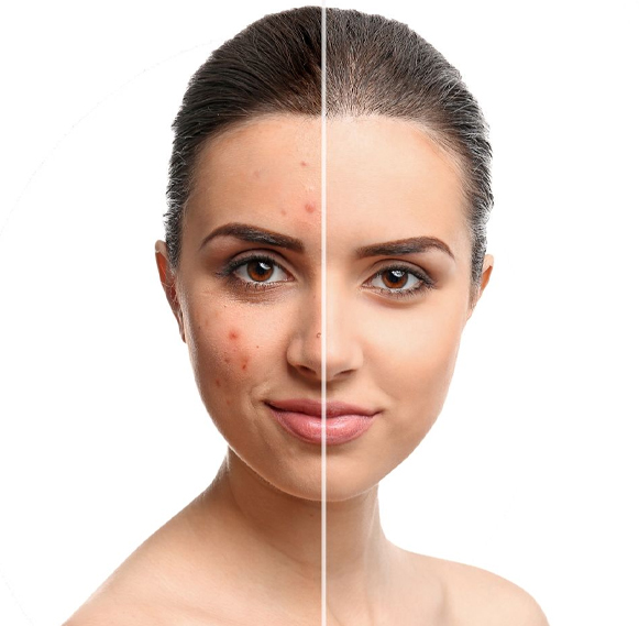 PhotoFacial Treatment in Ghaziabad & Delhi, PhotoFacial HD