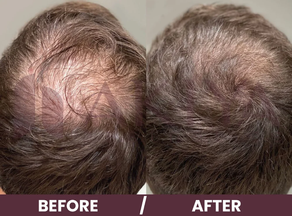 hair-prp-1before-after (1)
