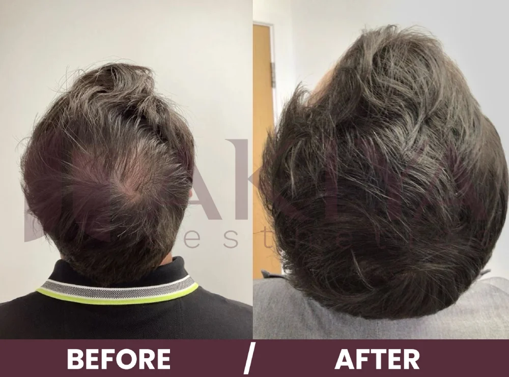 hair-prp-2before-after (1)