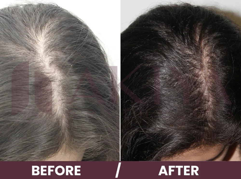 hair-prp-3before-after (1)