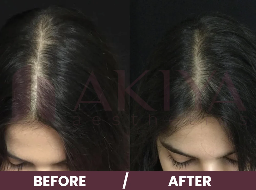 hair-prp-4before-after (1)