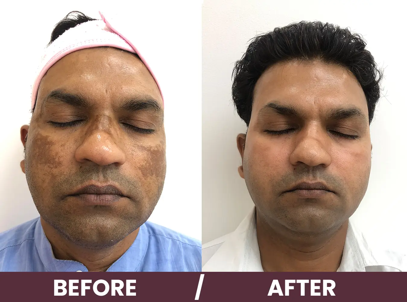 pigmentation-before-after2.webp