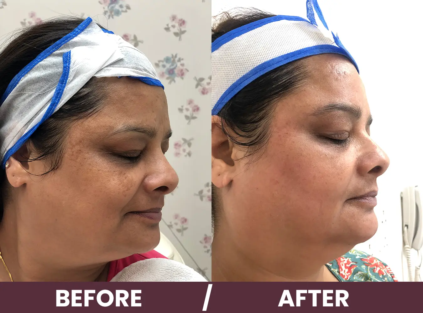 pigmentation-before-after3.webp