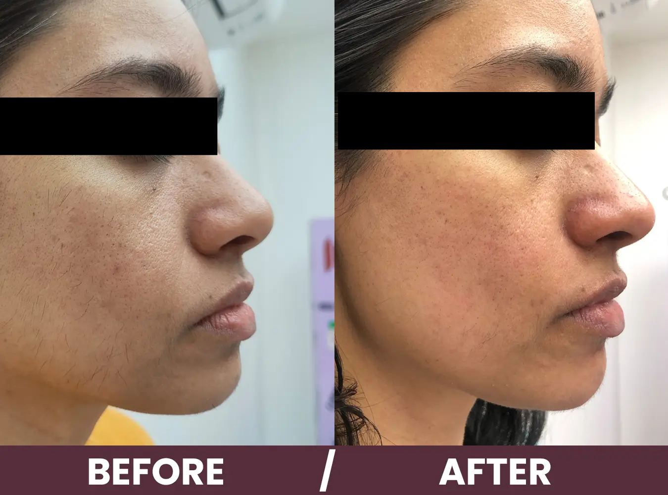 LHR-before-after3 skin clinic