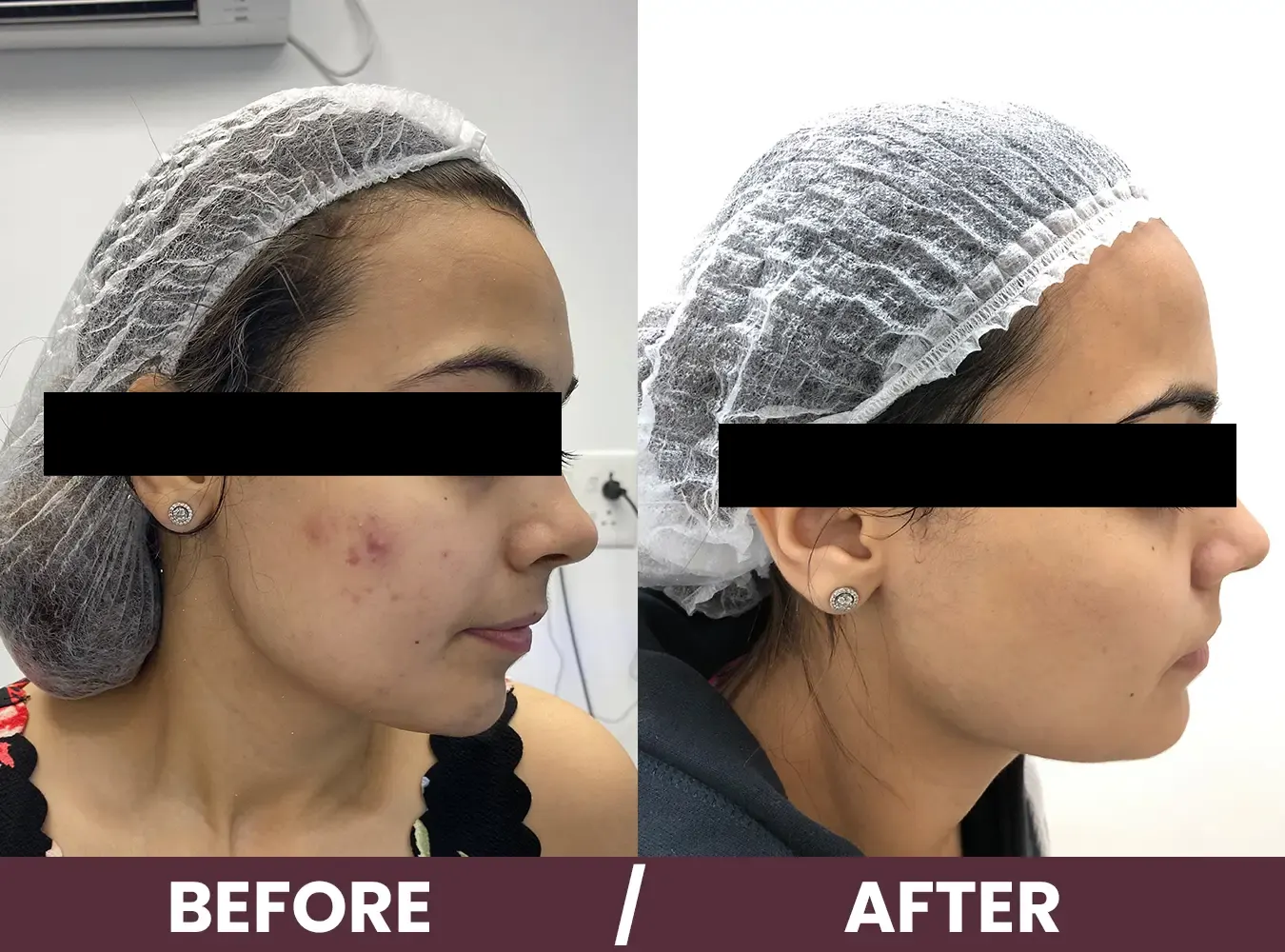 acne-before-after2 (1)