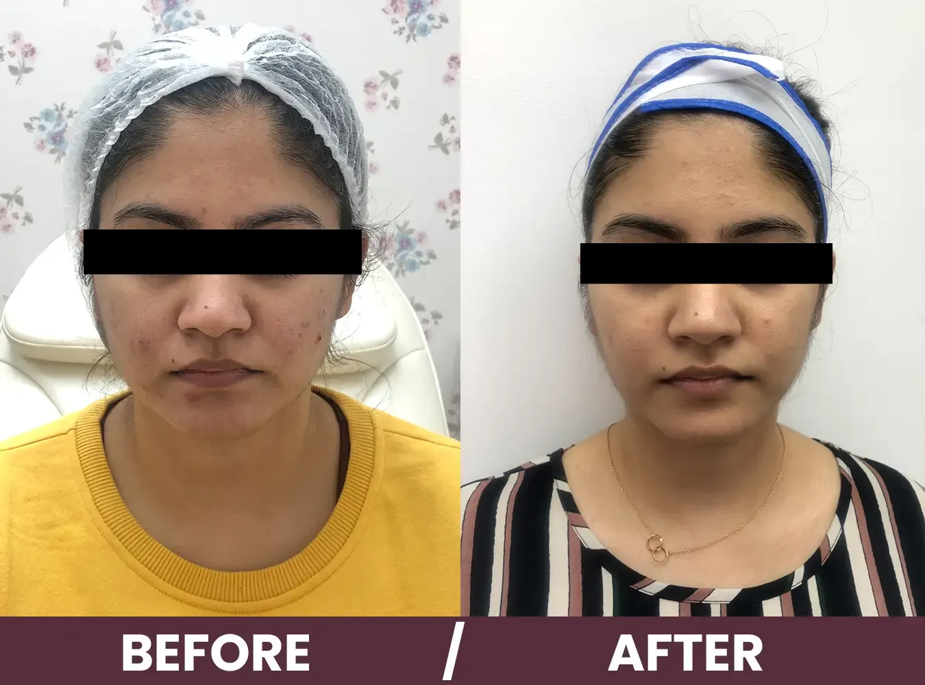 acne-before-after2 (2)