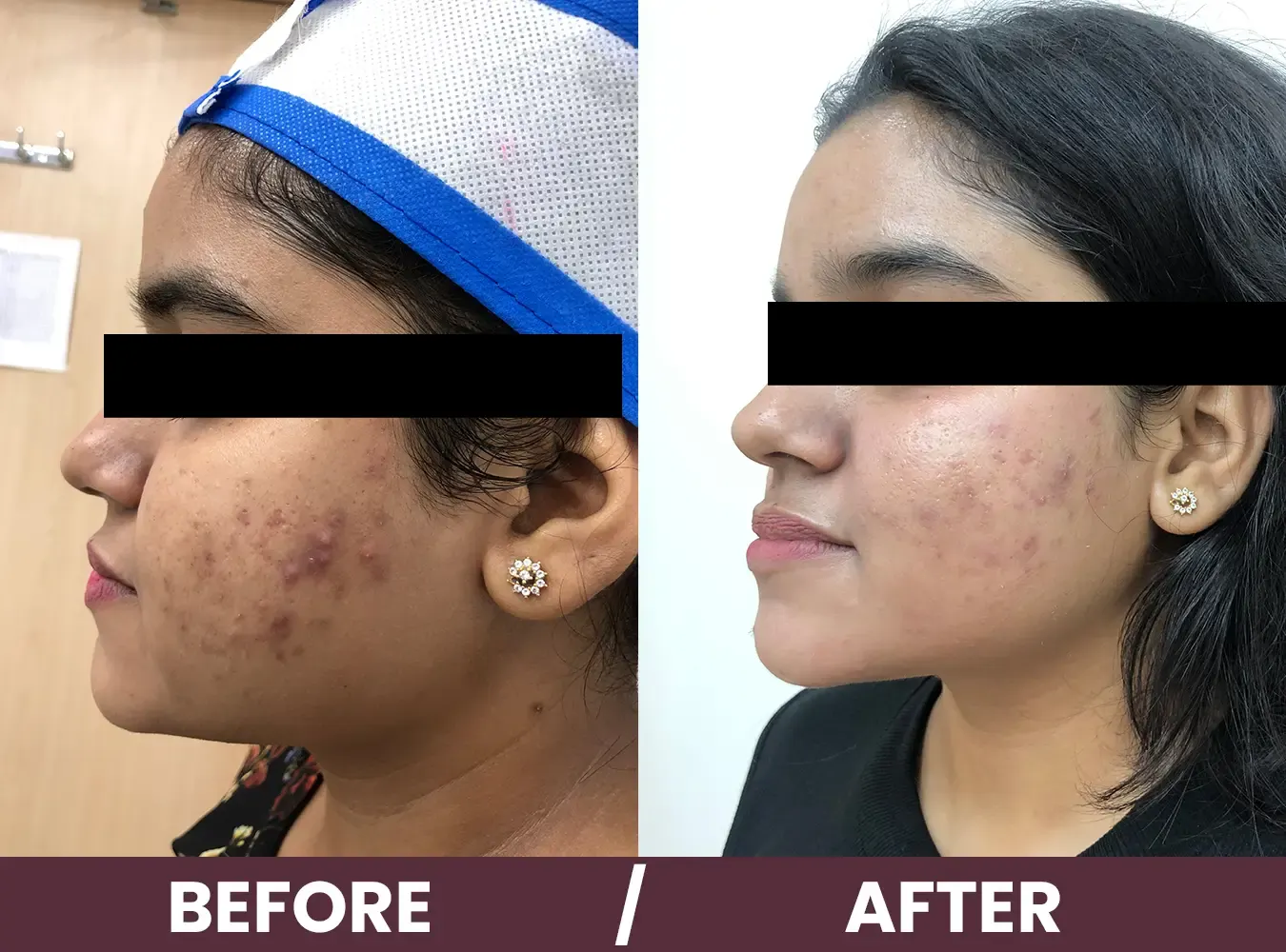 acne-before-after2